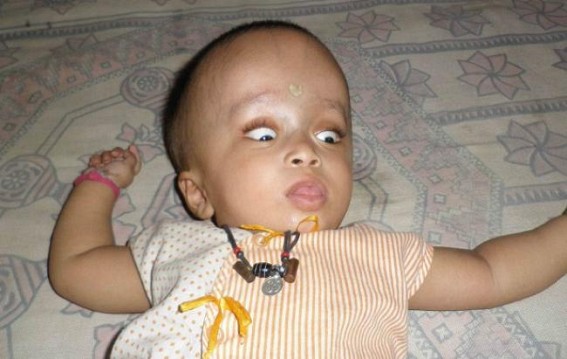 Kailasahar : Poor parents hoping for humanity to cure hydrocephalus attacked child Bibek Kailasahar : Poor parents hoping for humanity to cure hydrocephalus attacked child Bibek